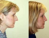 Before and after rhinoplasty pictures of removing dorsal hump