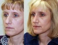 Information about before and after rhinoplasty