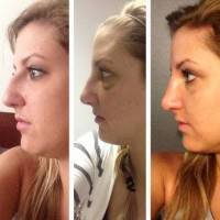 Rhinoplasty before and after nasal hump pictures nose job