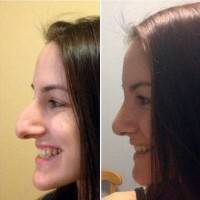 Rhinoplasty big nose to small nose before and after