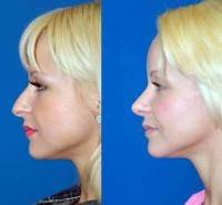 Rhinoplasty dorsal hump removal before and after photo