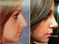 Rhinoplasty pictures before and after female