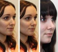 Rhinoplasty pictures of changing face