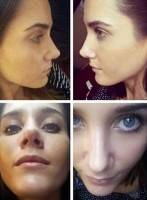 Closed rhinoplasty tip before and after