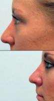 How much does rhinoplasty cost question