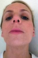 How much does rhinoplasty surgery cost