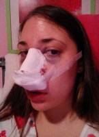 How old to get a nose job operation