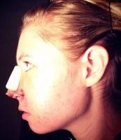 How to remove bump on nose naturally without operation