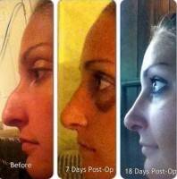 Open rhinoplasty operation recovery time