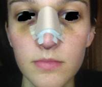 Open rhinoplasty recovery time picture