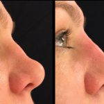 Osteotomy Rhinoplasty Before After (3)