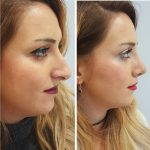 Osteotomy Rhinoplasty Before After (6)