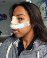 Recovery time after nose job cast after