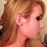 Rhinoplasty after pictures non surgical images