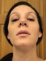 Asymmetrical nostrils after rhinoplasty surgery
