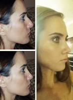 How long is nose job rhinoplasty surgery
