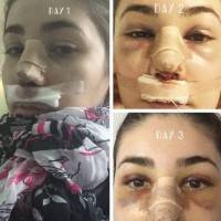 How to reduce swelling after rhinoplasty timeline