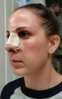 Rhinoplasty nose job under twilight sedation