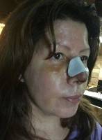 Rhinoplasty too old for surgery