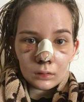 Risks of rhinoplasty nose job