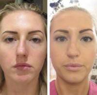 Septoplasty and rhinoplasty before and after pictures