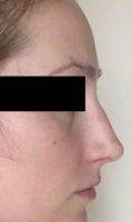 Beauty Nose Surgery In New York Reduce The Size Of The Nostrils