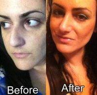 Before And After Rhinoplasty Surgery Procedure in Rochester NY