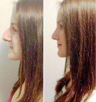 Brooklyn NYC Rhinoplasty Surgery Procedure Before And After