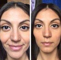 NY Large Nose Rhinoplasty Before after gallery photos