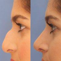 Nose Surgery Procedure Dubai Before After Pics Pics