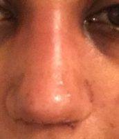 Perfect Nose Job Westchester New York Results