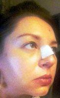 Reshaping Of Nose At Manhattan Facial Plastic Surgery