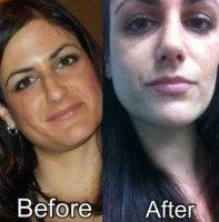 Rhinoplasty Nostrils New York City Pictures Before After