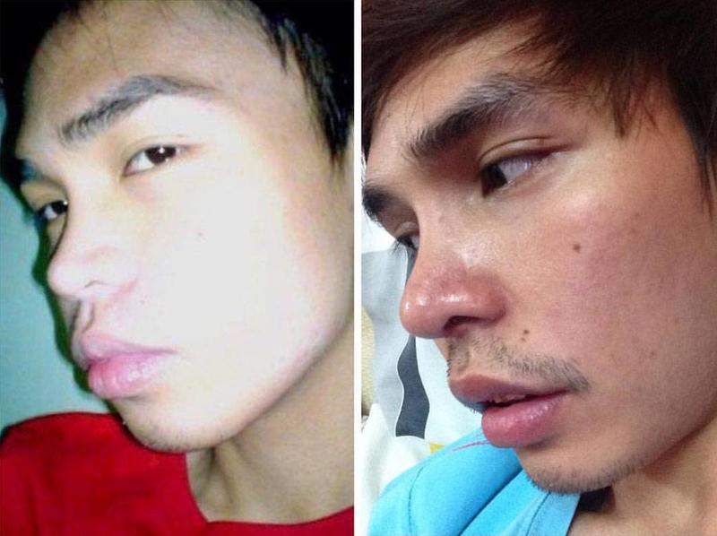 Asian Nose Job Before After 56