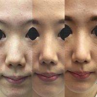 Asian Nose Nose Is Augmented Rather Than Reduced