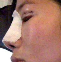 Asian Rhinoplasty For Small Nose In Saint Louis MO Is A Procedure Used To Improve The Shape Of The Nose