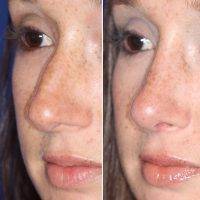 Before After Plastic Surgery On The Nose For Women In Los Angeles California
