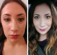 Nose Job NJ Women Before And After
