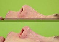 Nose Refinement In Tallahassee Florida