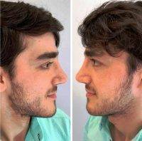 Nose Surgery Procedure For Man Before And After Images