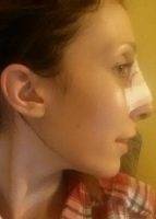 Rhinoplasty Plastic Surgery Clearwater FL Results