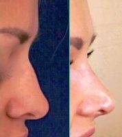 Affordable Rhinoplasty NC Before And After Pics