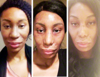 African American Surgical Rhinoplasty New Mexico Patient