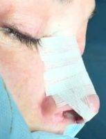 Ahmedabad India Plastic Nose Is One Of The Most Common Of All Plastic Surgery Procedures