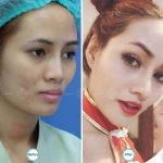 Asian Nose Augmentation Photos (1)