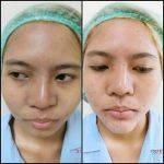 Asian Nose Augmentation Photos (3)
