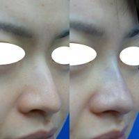 Asian Nose Lift In Indianapolis Images Preop And Postop