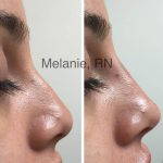Augmentation Rhinoplasty Before And After Photos (1)