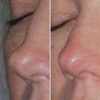 Augmentation Rhinoplasty Is Necessary For Both Aesthetic And Functional Indications