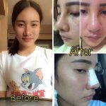 Augmentation Rhinoplasty Recovery Pictures